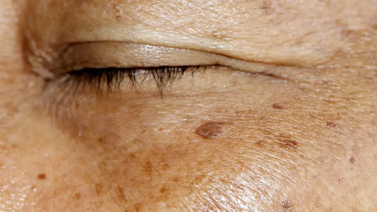 Nahaufnahme der Haut um das Auge mit Altersflecken. Ein Beispiel für Hautveränderungen, die mit Methoden zur Altersfleckenentfernung behandelt werden können.
