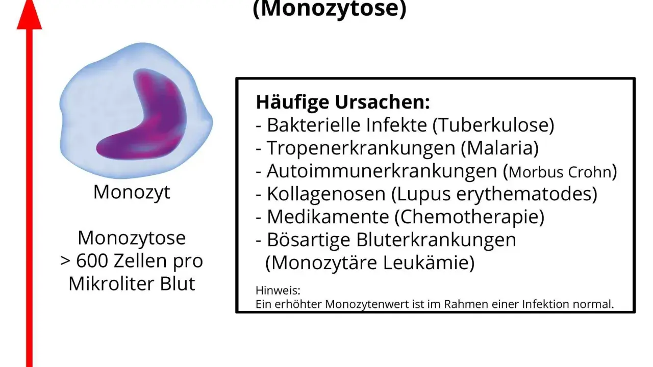 Erhöhte Monozyten (Monozytose) können auf Infektionen, Autoimmunerkrankungen oder bösartige Blutkrankheiten hinweisen. Der Normwert liegt bei 285-500 Zellen/µl.