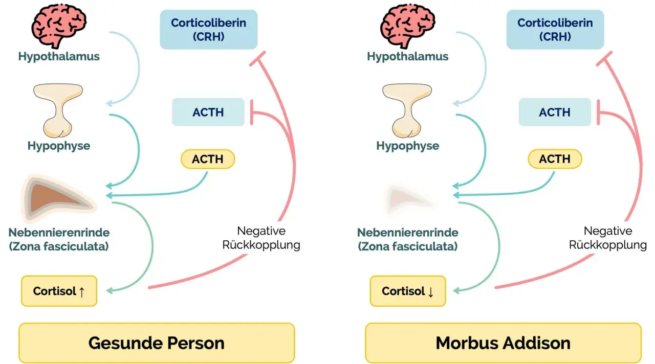 Schema zeigt die Hormonregulation bei gesunden Personen und bei Morbus Addison. Bei Morbus Addison ist die Cortisolproduktion erniedrigt.