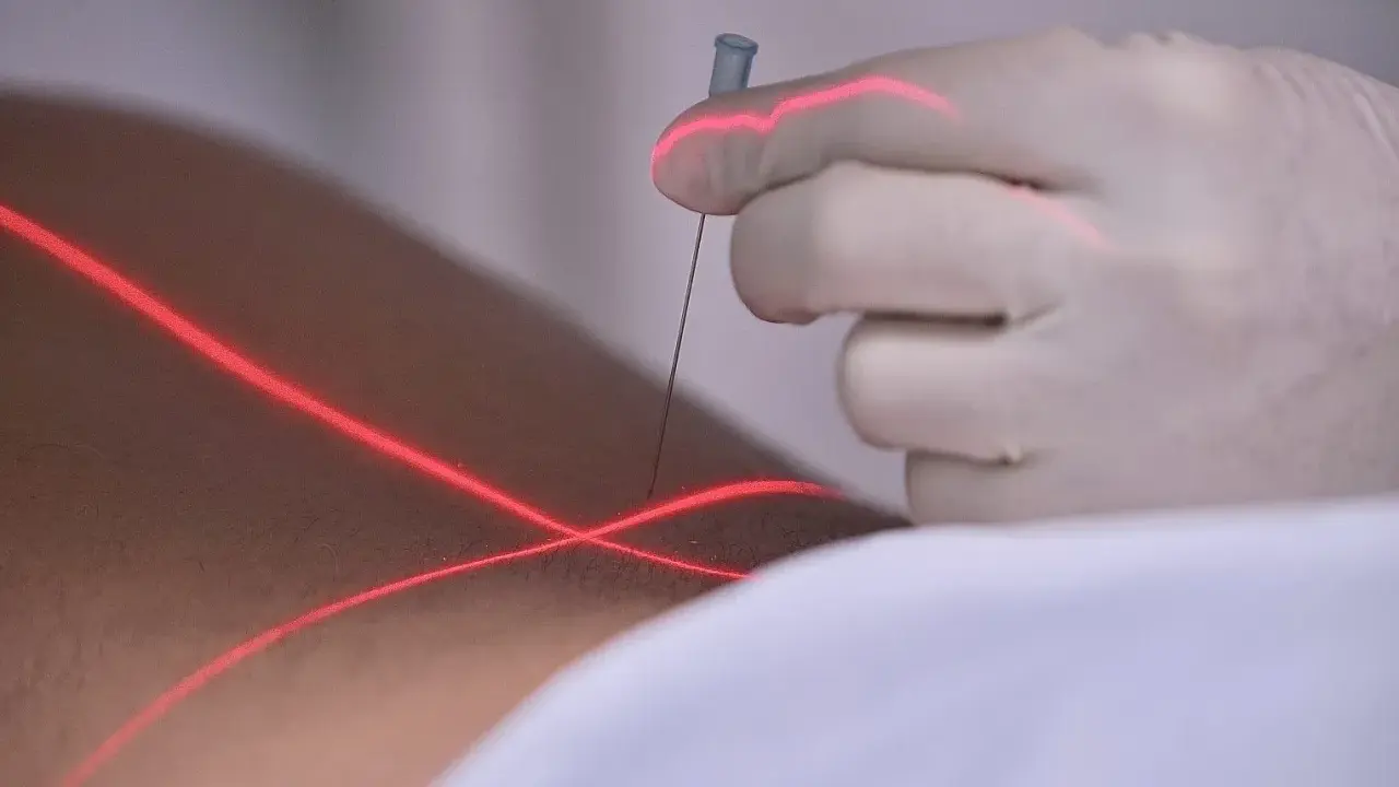Eine Hand in einem weißen Handschuh hält eine prt spritze, während rote Laserlinien über die Haut gleiten.