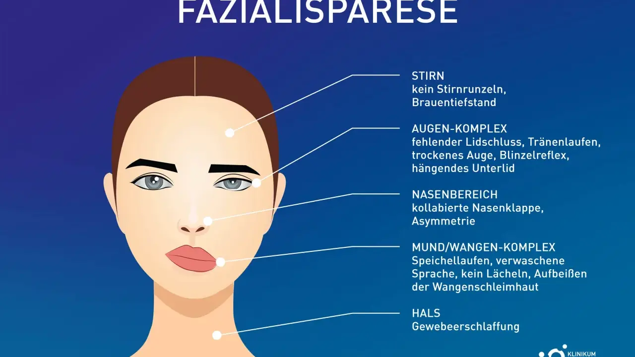 Illustration zeigt Fazialisparese-Symptome: Stirnfalten fehlen, Auge schließt nicht, Mundwinkel hängt, was zu einem Gefühl von Kribbeln im Gesicht führen kann.
