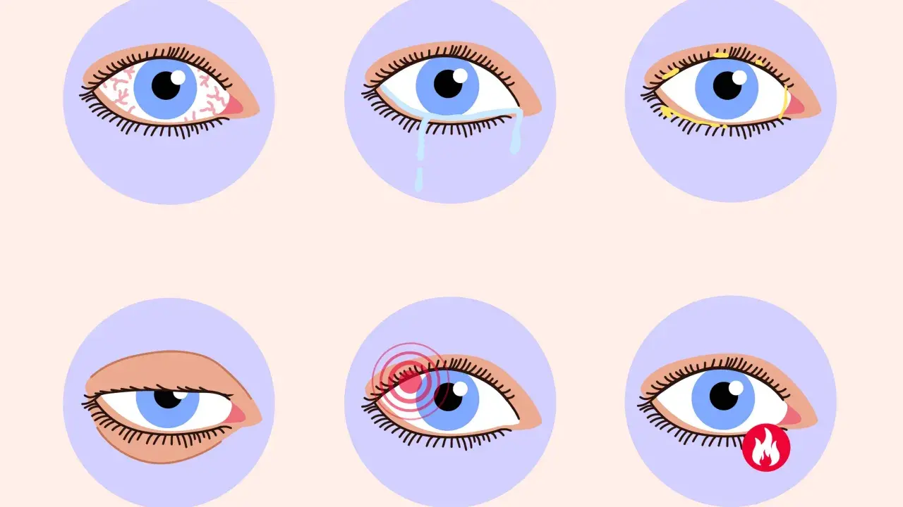 Augenprobleme wie Rötung, Tränenfluss, Verkrustung, Schmerz und Brennen können auf trockene Augen und Vitaminmangel hindeuten.