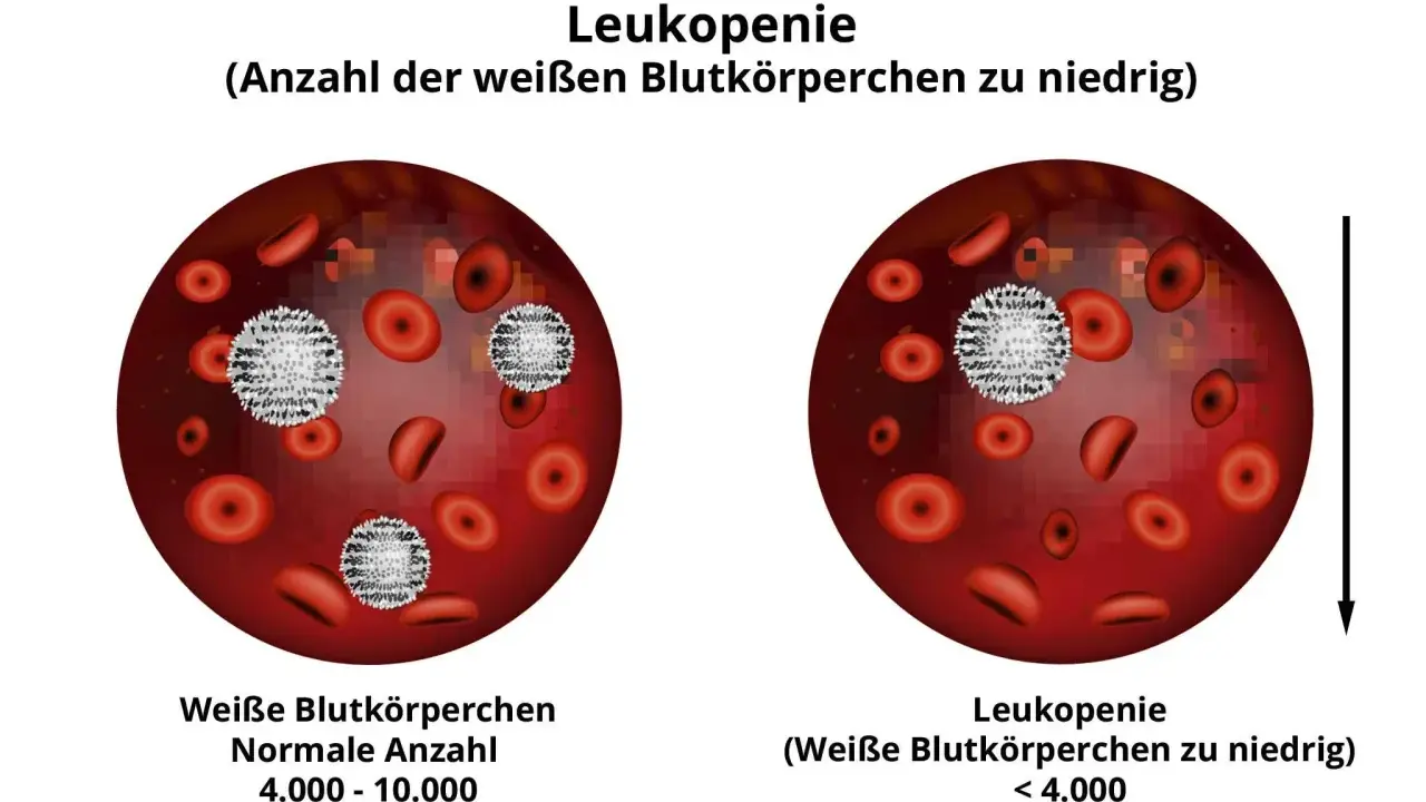 Vergleich von Blutbildern: Links normale Anzahl weißer Blutkörperchen, rechts Leukopenie (weiße Blutkörperchen zu niedrig).