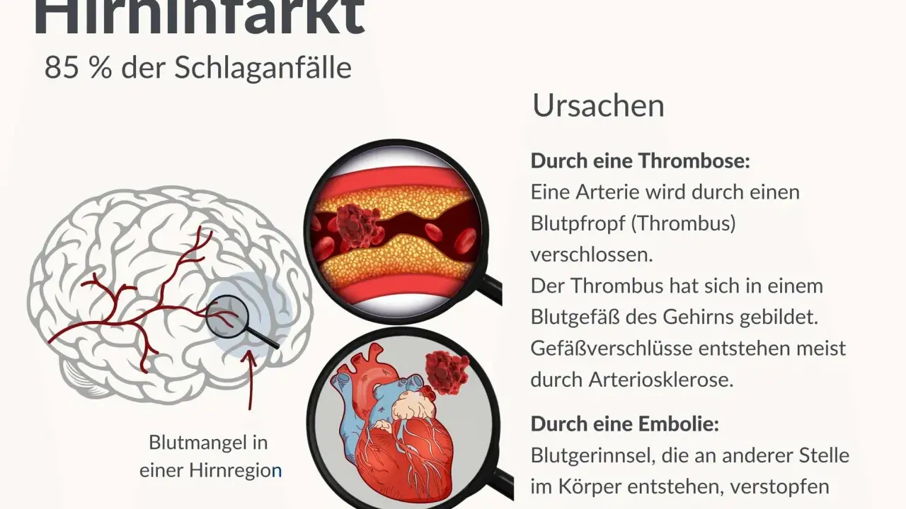 Illustration zeigt Hirninfarkt, Ursachen wie Thrombose/Embolie und Blutarmut in Hirnregion. Der demenz nach schlaganfall verlauf kann hier beginnen.