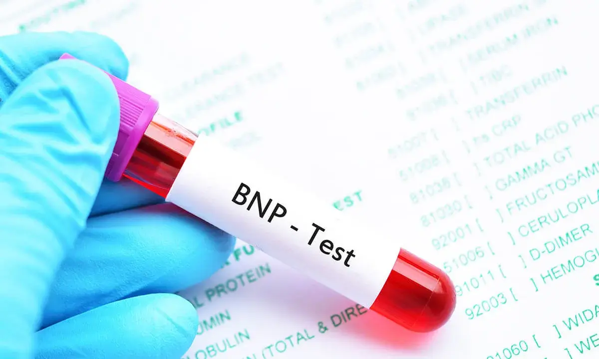 Blauer Handschuh hält Blutprobe für BNP-Test. Laborbericht im Hintergrund zeigt verschiedene Werte, darunter auch den BNP Wert.