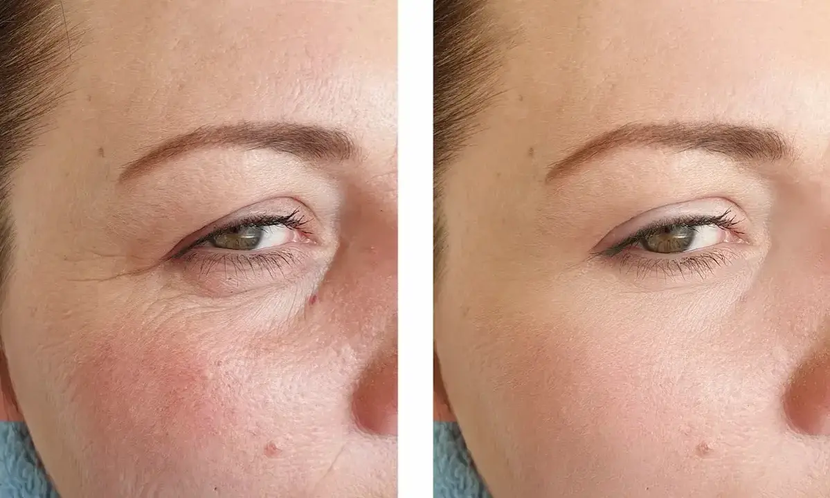 Vorher-Nachher-Vergleich zeigt die beeindruckende **Retinol Wirkung** auf die Haut. Falten sind sichtbar reduziert, die Haut wirkt glatter und jugendlicher.