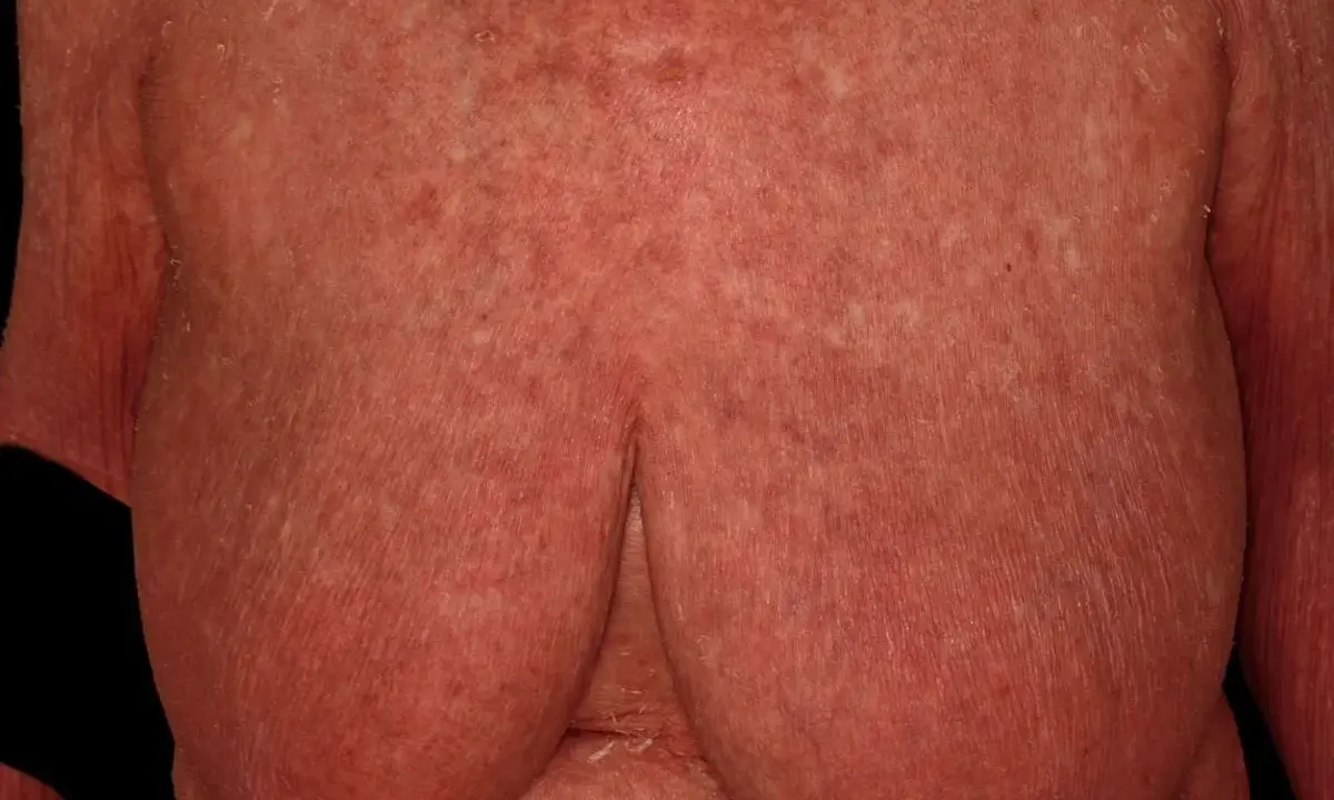 Hautveränderungen, die auf Pityriasis rubra pilaris hindeuten, zeigen sich als rote, schuppende Flecken auf der Brust und den Armen.