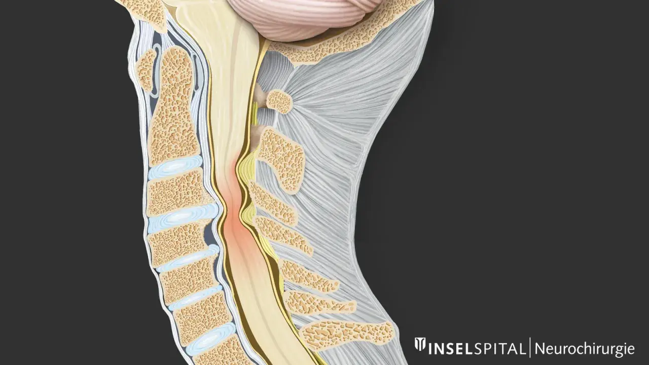 Illustration zeigt eine Kompression des Rückenmarks im Halsbereich, die zu zervikaler Myelopathie führen kann. Die Lebenserwartung hängt von der Schwere ab.