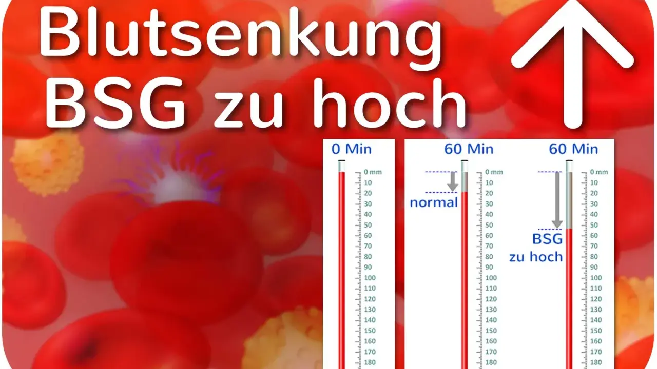 Blutsenkung: BSG zu hoch. Rote Blutkörperchen und Messzylinder zeigen eine erhöhte BSG an, was auf Entzündungen hindeuten kann.