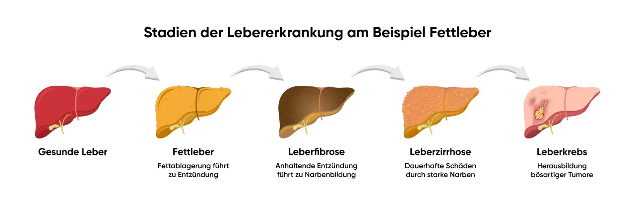 Illustration zeigt Stadien der Lebererkrankung: gesunde Leber, Fettleber, Leberfibrose, Leberzirrhose und Leberkrebs. Was tun bei Fettleber? Frühzeitige Behandlung ist wichtig.