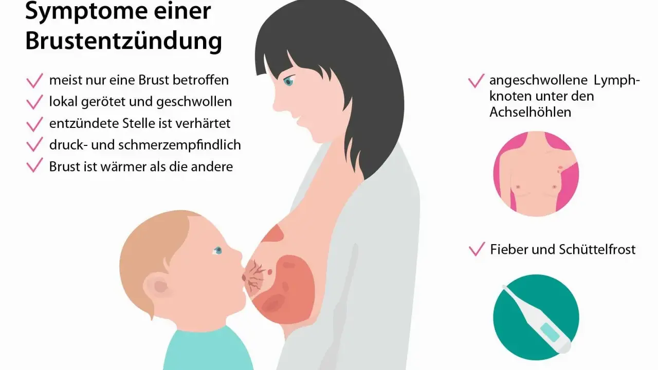 Brustentzündung: Rötung, Schwellung, Verhärtung, Schmerz, Wärme, Lymphknotenschwellung, Fieber. Dies sind häufige milchstau symptome.