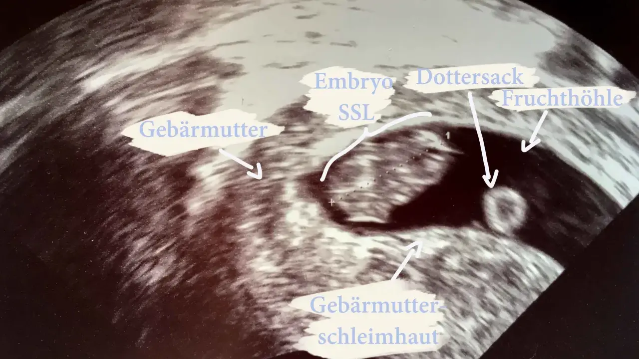 Ultraschallbild zeigt frühe Schwangerschaft: Gebärmutter, Fruchtblase, Dottersack und Embryo (SSL).