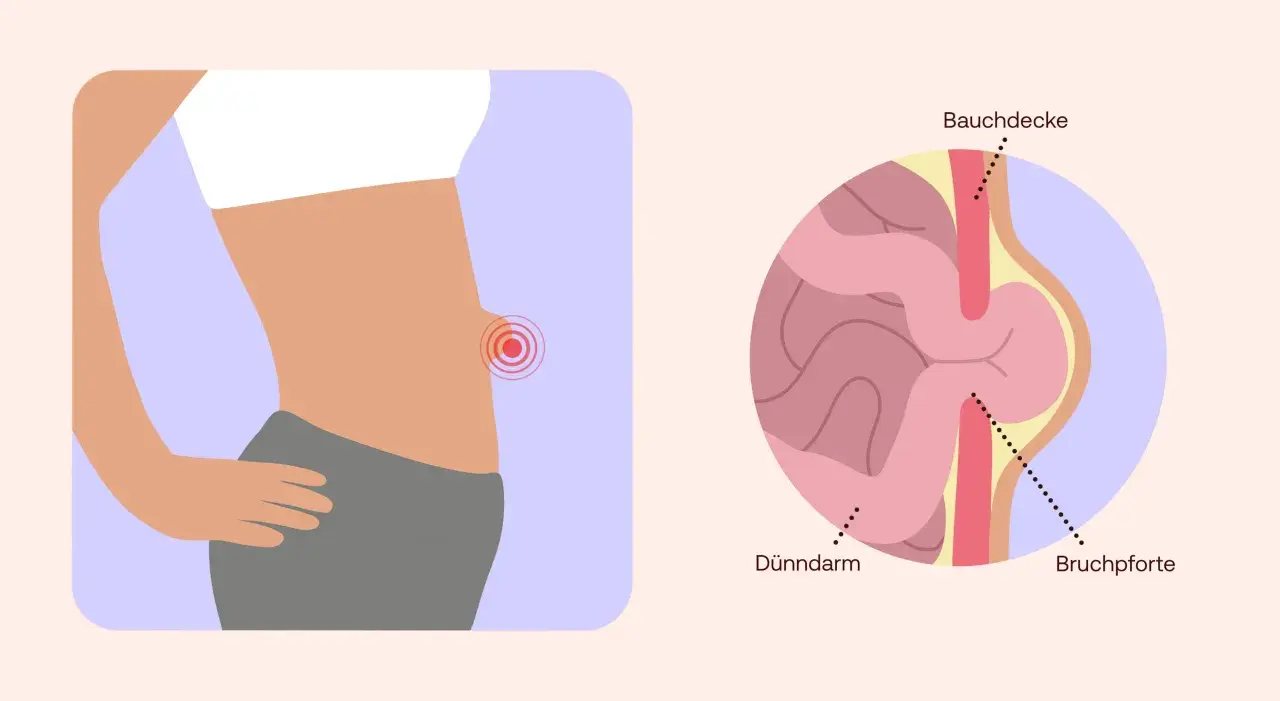 Illustration zeigt einen Bauch mit einem roten Schmerzpunkt und eine Nahaufnahme eines Nabelbruchs, der Dünndarm durch die Bauchdecke drückt. Nabelbruch Symptome.