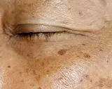 Nahaufnahme der Haut um das Auge mit Altersflecken. Ein Beispiel für Hautveränderungen, die mit Methoden zur Altersfleckenentfernung behandelt werden können.