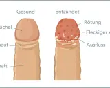 Vergleich von gesunder Eichel und entzündeter Eichel mit roten Punkten, Rötung, fleckigem Ausschlag und Ausfluss.