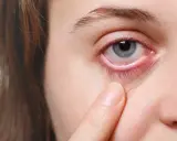 Ein blasses Unterlid und gerötete Augen können Anzeichen von Blutarmut im Alter sein.