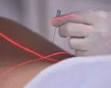 Eine Hand in einem weißen Handschuh hält eine prt spritze, während rote Laserlinien über die Haut gleiten.