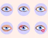 Augenprobleme wie Rötung, Tränenfluss, Verkrustung, Schmerz und Brennen können auf trockene Augen und Vitaminmangel hindeuten.