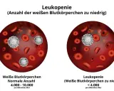 Vergleich von Blutbildern: Links normale Anzahl weißer Blutkörperchen, rechts Leukopenie (weiße Blutkörperchen zu niedrig).