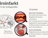 Illustration zeigt Hirninfarkt, Ursachen wie Thrombose/Embolie und Blutarmut in Hirnregion. Der demenz nach schlaganfall verlauf kann hier beginnen.