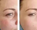 Vorher-Nachher-Vergleich zeigt die beeindruckende **Retinol Wirkung** auf die Haut. Falten sind sichtbar reduziert, die Haut wirkt glatter und jugendlicher.