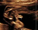Ultraschallbild eines Babys in der 20. SSW. Der Pfeil zeigt auf die Genitalien, die auf XY-Chromosomen hindeuten.