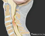 Illustration zeigt eine Kompression des Rückenmarks im Halsbereich, die zu zervikaler Myelopathie führen kann. Die Lebenserwartung hängt von der Schwere ab.
