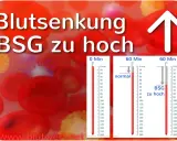 Blutsenkung: BSG zu hoch. Rote Blutkörperchen und Messzylinder zeigen eine erhöhte BSG an, was auf Entzündungen hindeuten kann.
