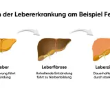 Illustration zeigt Stadien der Lebererkrankung: gesunde Leber, Fettleber, Leberfibrose, Leberzirrhose und Leberkrebs. Was tun bei Fettleber? Frühzeitige Behandlung ist wichtig.
