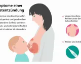 Brustentzündung: Rötung, Schwellung, Verhärtung, Schmerz, Wärme, Lymphknotenschwellung, Fieber. Dies sind häufige milchstau symptome.