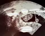 Ultraschallbild zeigt frühe Schwangerschaft: Gebärmutter, Fruchtblase, Dottersack und Embryo (SSL).