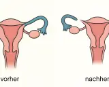 Vergleich: Gebärmutter mit durchgängigen Eileitern (vorher) und nach Sterilisation Frau (nachher), wo die Eileiter unterbrochen sind.
