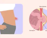 Illustration zeigt einen Bauch mit einem roten Schmerzpunkt und eine Nahaufnahme eines Nabelbruchs, der Dünndarm durch die Bauchdecke drückt. Nabelbruch Symptome.