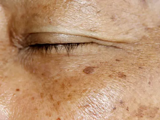 Nahaufnahme der Haut um das Auge mit Altersflecken. Ein Beispiel für Hautveränderungen, die mit Methoden zur Altersfleckenentfernung behandelt werden können.