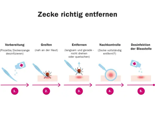 Schritt-für-Schritt-Anleitung zur zecke entfernen: Vorbereitung, Greifen, Entfernen, Nachkontrolle und Desinfektion der Bissstelle.