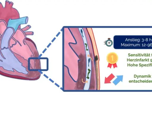 Herzinfarkt-Diagnostik: Ein erhöhter troponin wert ist entscheidend. Sensitivität 94%, Anstieg 3-8h, Maximum 12-96h. Dynamik zählt.