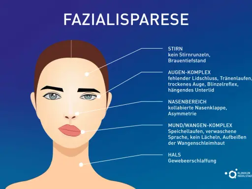Illustration zeigt Fazialisparese-Symptome: Stirnfalten fehlen, Auge schließt nicht, Mundwinkel hängt, was zu einem Gefühl von Kribbeln im Gesicht führen kann.