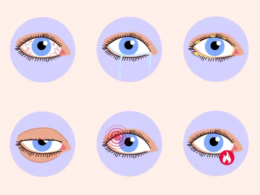 Augenprobleme wie Rötung, Tränenfluss, Verkrustung, Schmerz und Brennen können auf trockene Augen und Vitaminmangel hindeuten.