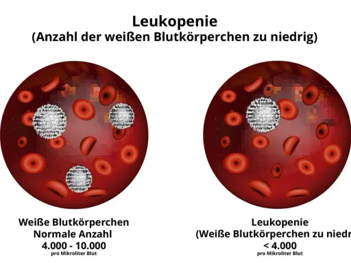 Vergleich von Blutbildern: Links normale Anzahl weißer Blutkörperchen, rechts Leukopenie (weiße Blutkörperchen zu niedrig).