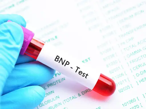 Blauer Handschuh hält Blutprobe für BNP-Test. Laborbericht im Hintergrund zeigt verschiedene Werte, darunter auch den BNP Wert.