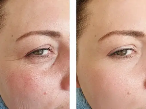 Vorher-Nachher-Vergleich zeigt die beeindruckende **Retinol Wirkung** auf die Haut. Falten sind sichtbar reduziert, die Haut wirkt glatter und jugendlicher.