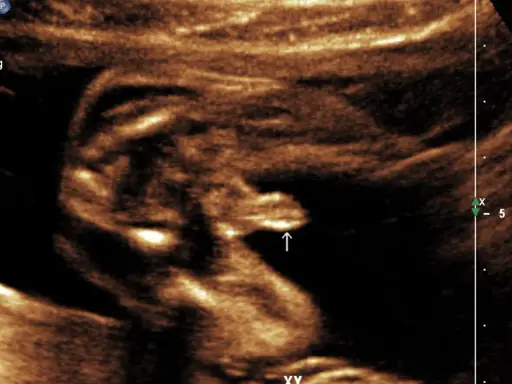 Ultraschallbild eines Babys in der 20. SSW. Der Pfeil zeigt auf die Genitalien, die auf XY-Chromosomen hindeuten.