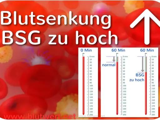 Blutsenkung: BSG zu hoch. Rote Blutkörperchen und Messzylinder zeigen eine erhöhte BSG an, was auf Entzündungen hindeuten kann.