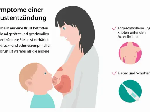 Brustentzündung: Rötung, Schwellung, Verhärtung, Schmerz, Wärme, Lymphknotenschwellung, Fieber. Dies sind häufige milchstau symptome.