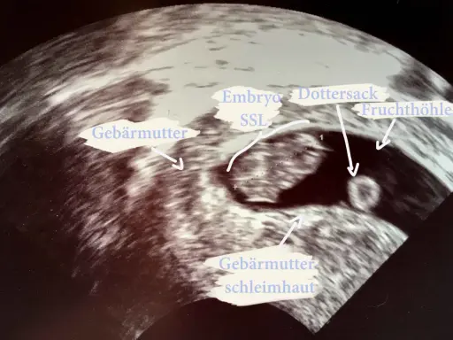 Ultraschallbild zeigt frühe Schwangerschaft: Gebärmutter, Fruchtblase, Dottersack und Embryo (SSL).