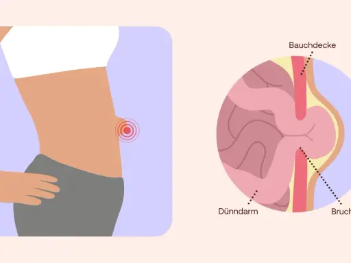 Illustration zeigt einen Bauch mit einem roten Schmerzpunkt und eine Nahaufnahme eines Nabelbruchs, der Dünndarm durch die Bauchdecke drückt. Nabelbruch Symptome.