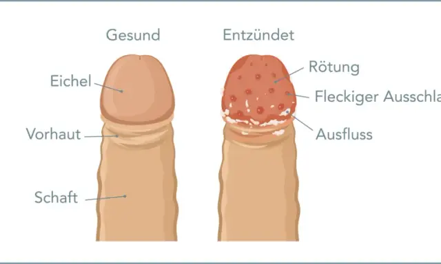 Vergleich von gesunder Eichel und entzündeter Eichel mit roten Punkten, Rötung, fleckigem Ausschlag und Ausfluss.