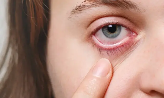 Ein blasses Unterlid und gerötete Augen können Anzeichen von Blutarmut im Alter sein.