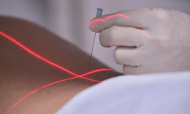 Eine Hand in einem weißen Handschuh hält eine prt spritze, während rote Laserlinien über die Haut gleiten.