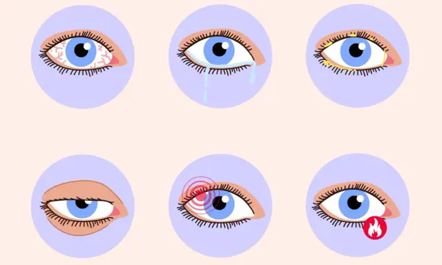 Augenprobleme wie Rötung, Tränenfluss, Verkrustung, Schmerz und Brennen können auf trockene Augen und Vitaminmangel hindeuten.